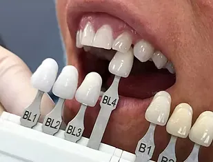 Shade guide tabs held next to a patient’s teeth during a shade match